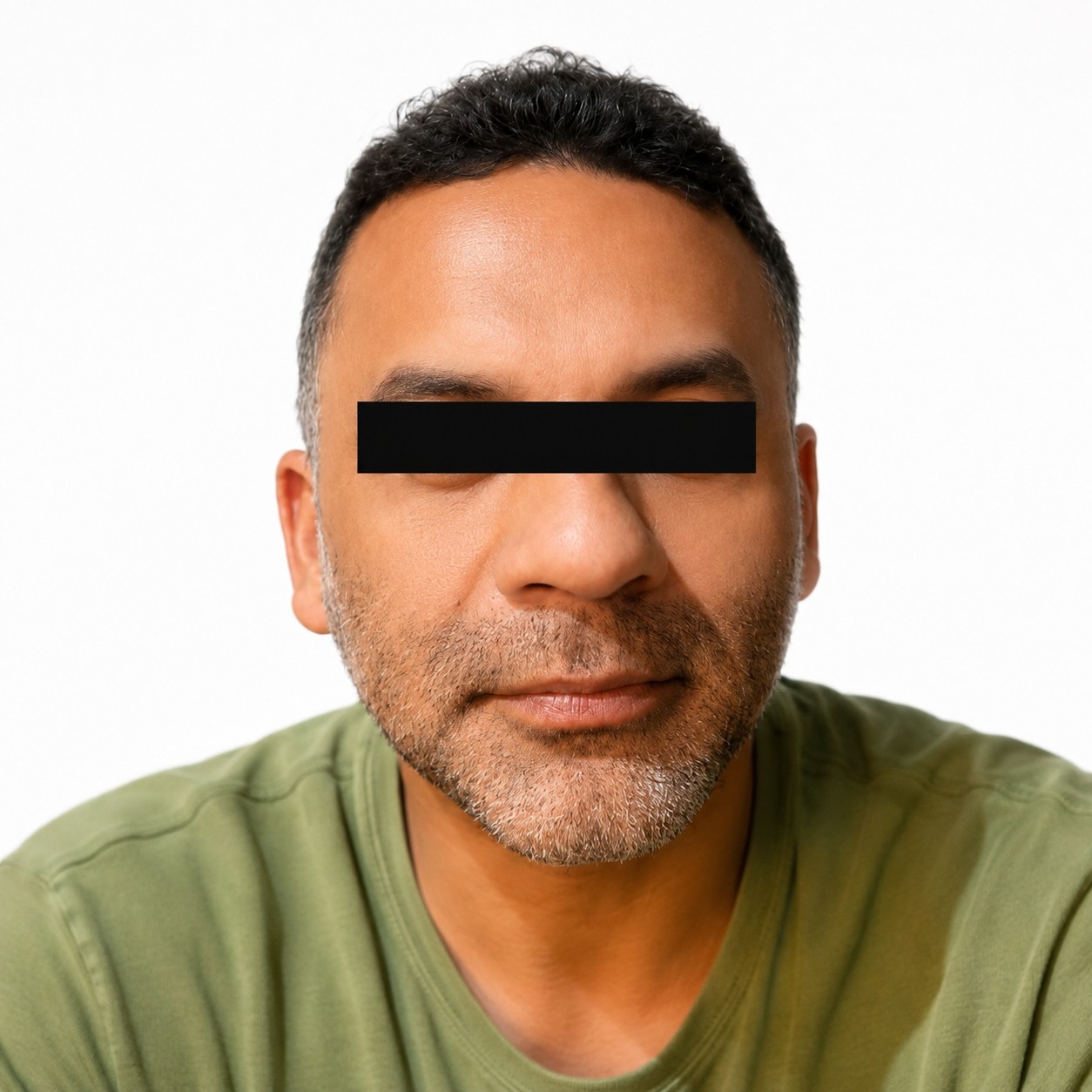 Después de armonización facial